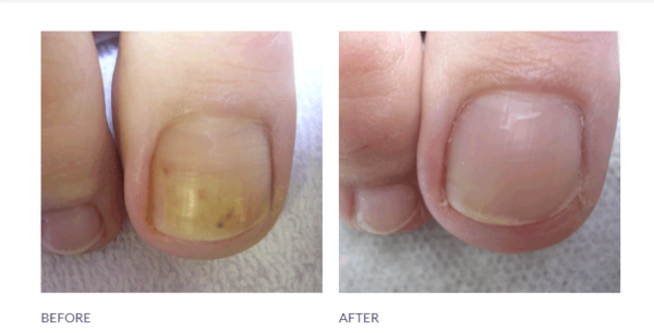 Anti-Fungal Toe Tincture Spray - Image 2